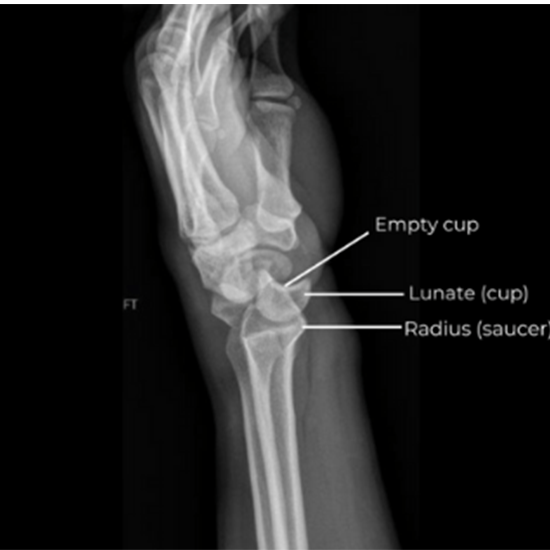 X-Ray Wrist (LAT View) Lateral